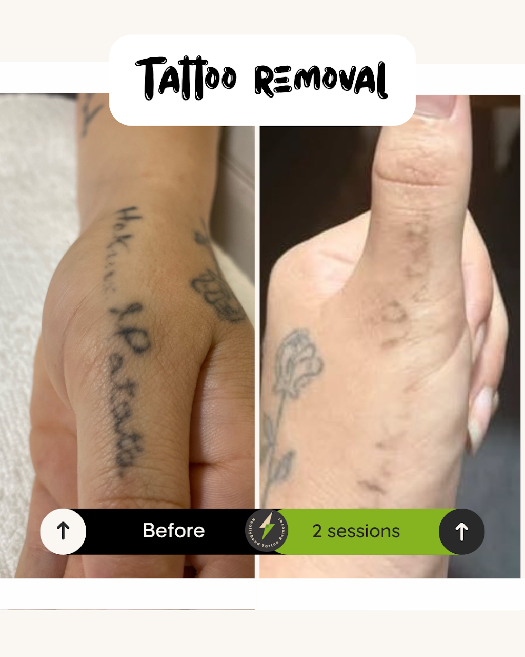 Really Good Tattoo Removal | 47 Clayton St, Sandgate QLD 4017, Australia | Phone: 0413 006 477