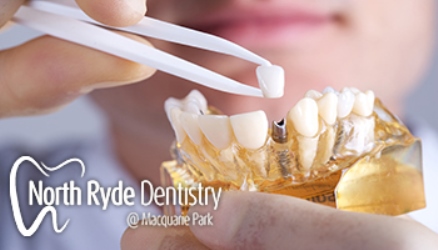 North Ryde Dentistry | B, 4/64 Talavera Rd, Macquarie Park NSW 2113, Australia | Phone: (02) 8090 1102