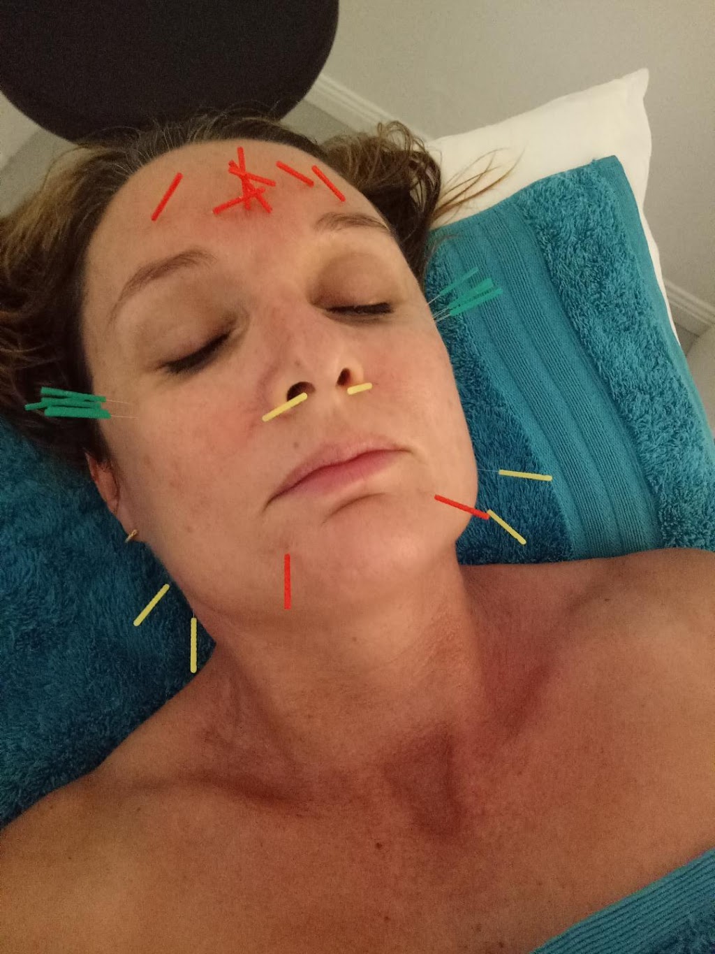 Acupuncture with Leah Baldwin | 3 Waranga Ct, Murrumba Downs QLD 4503, Australia | Phone: 0402 123 002