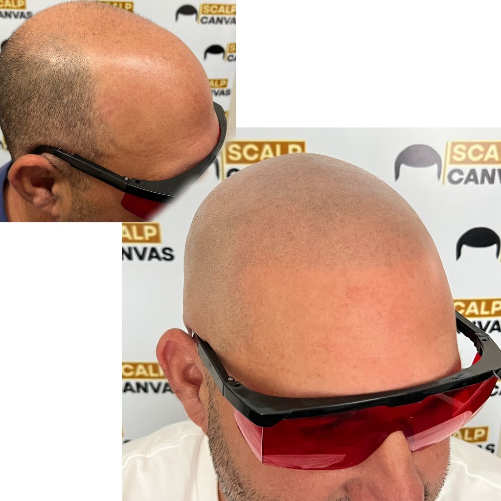 Scalp Canvas - Scalp Micropigmentation Sydney | 1 Inverness Cct, Cecil Hills NSW 2171, Australia | Phone: 0414 400 454
