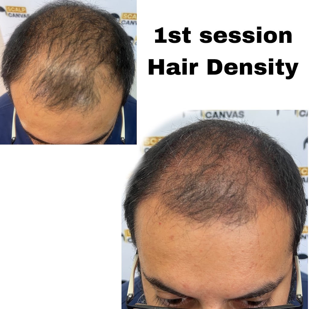 Scalp Canvas - Scalp Micropigmentation Sydney | 1 Inverness Cct, Cecil Hills NSW 2171, Australia | Phone: 0414 400 454