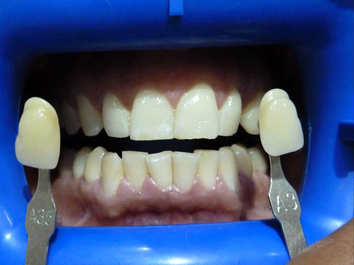 TFI Dentistry | dentist | 1/84 Brisbane Rd, Labrador QLD 4215, Australia | 0755288222 OR +61 7 5528 8222
