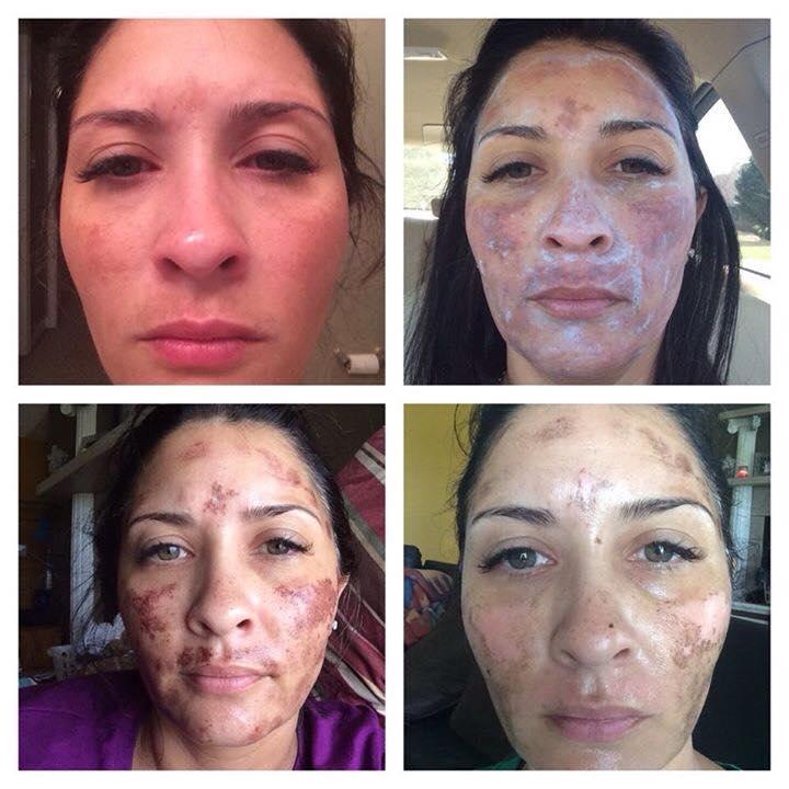 Beauty Stone Skin Care & Laser Clinic | 117 Ware St, Fairfield NSW 2165, Australia | Phone: 0423 228 338