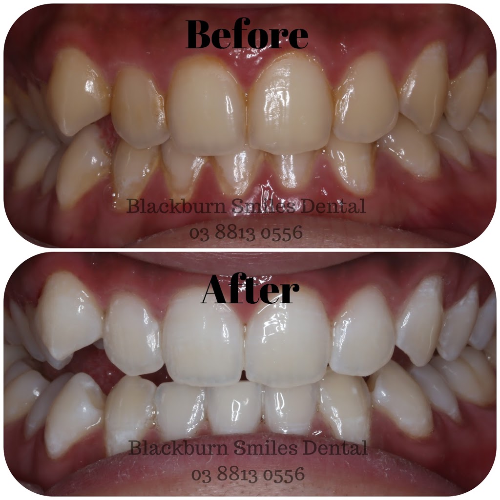 Blackburn Smiles Dental | 141 Canterbury Rd, Blackburn VIC 3130, Australia | Phone: (03) 8813 0556