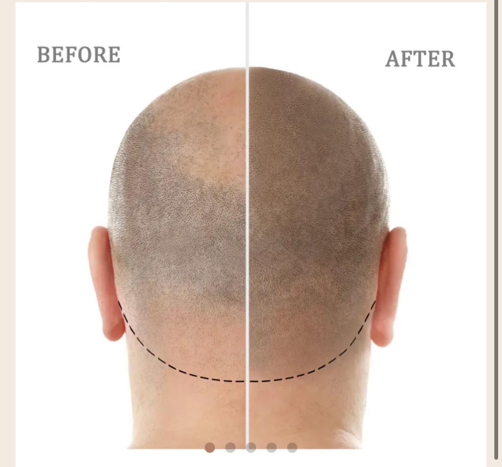 Scalp Canvas - Scalp Micropigmentation Sydney | 1 Inverness Cct, Cecil Hills NSW 2171, Australia | Phone: 0414 400 454
