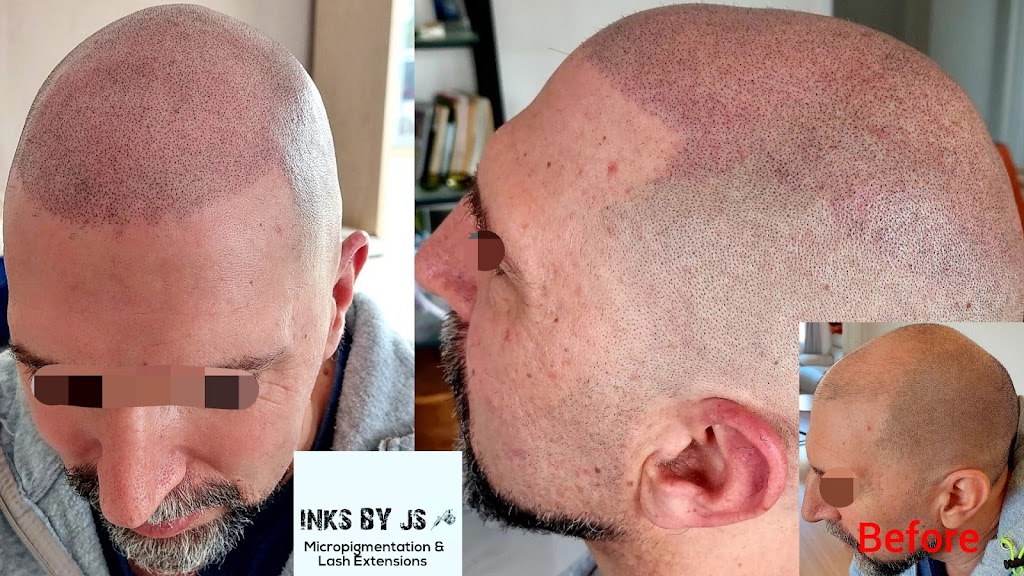 Scalp Micropigmentation SMP Melbourne Inks by JS | Sayers Rd, Tarneit VIC 3029, Australia | Phone: 0421 844 551