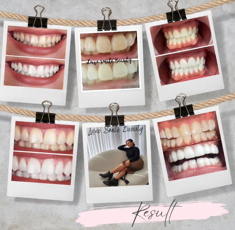 Luxe Smile Beauty | 6 Garema Rd, Gwandalan NSW 2259, Australia | Phone: 0412 922 689