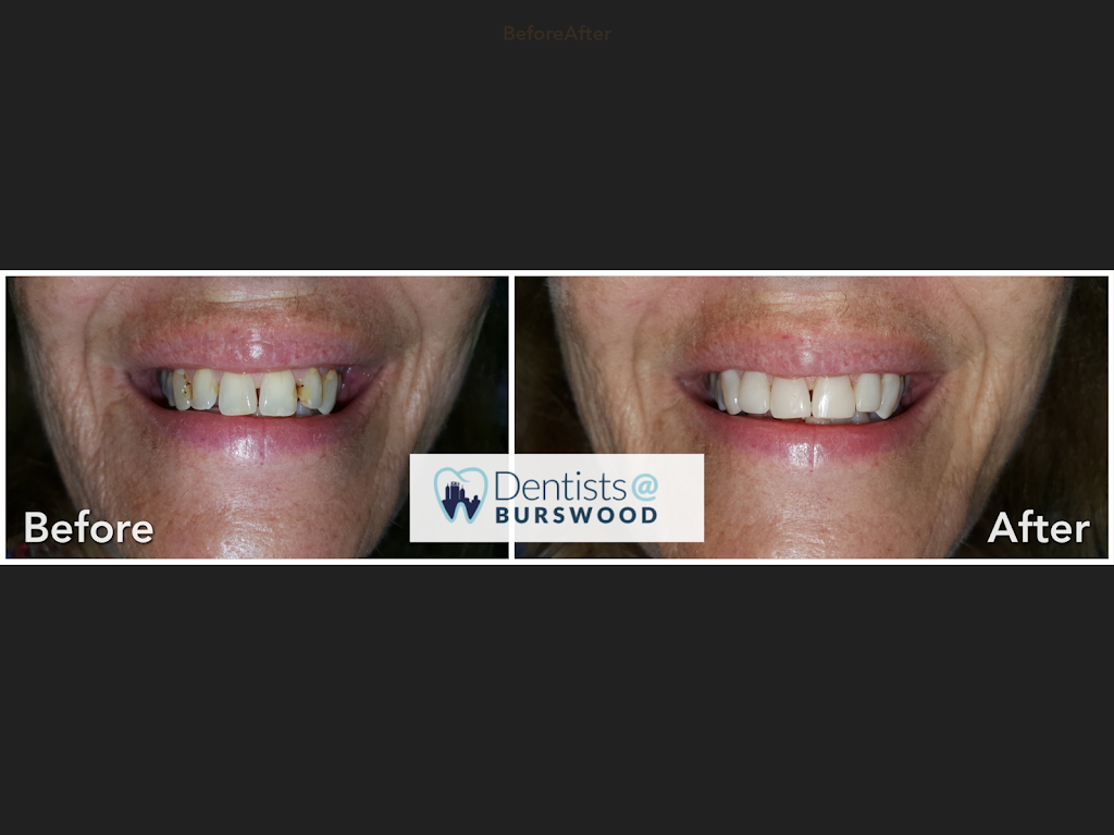 Dentists@Burswood | 1/107-109 Orrong Rd, Rivervale WA 6103, Australia | Phone: (08) 9361 2796