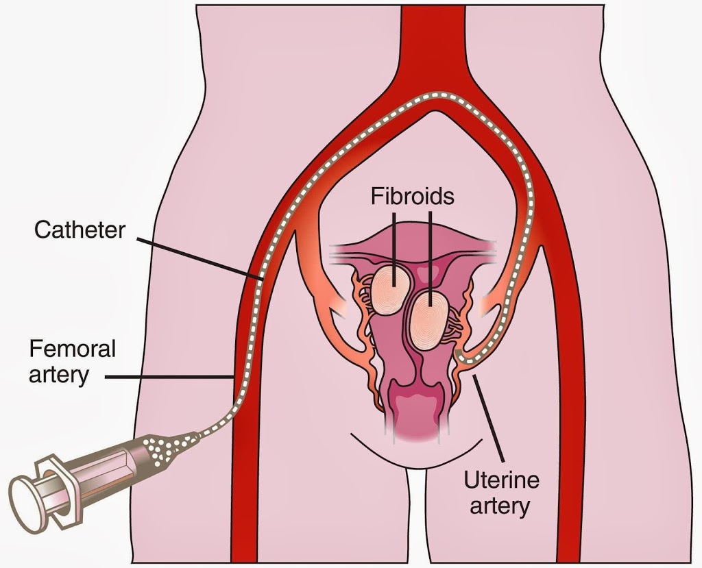 Sydney Fibroid Clinic (Wahroonga) | Suite 407, San Clinic, 185 Fox Valley Rd, Wahroonga NSW 2076, Australia | Phone: (02) 9473 8728