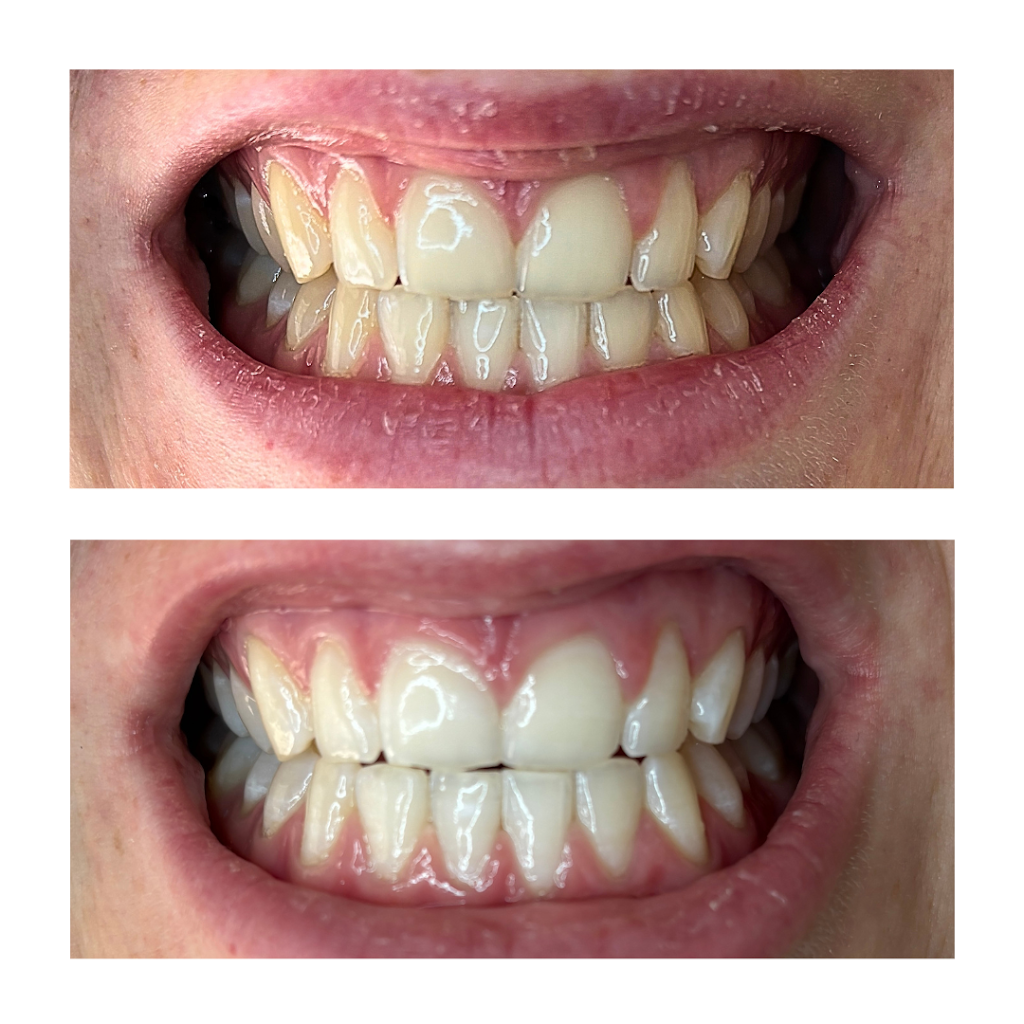 The Whitening Room | MacDougall Rd, Golden Gully VIC 3555, Australia | Phone: 0426 284 861