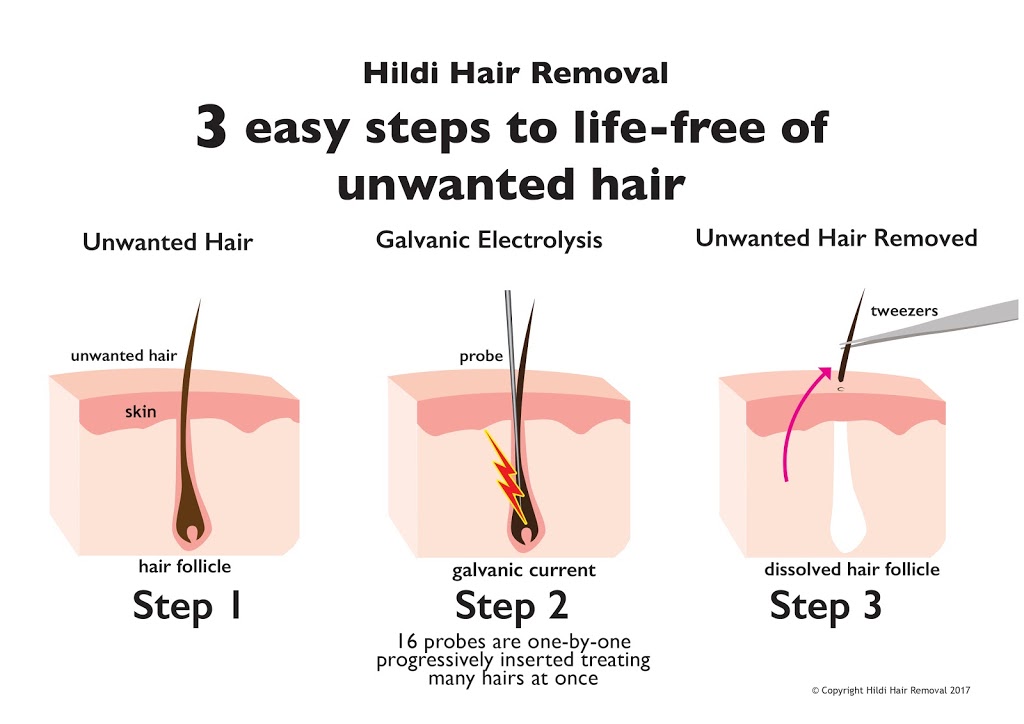 Hildi Hair Removal | hair care | 6/8-12 Copernicus Way, Keilor Downs VIC 3038, Australia | 0393569426 OR +61 3 9356 9426