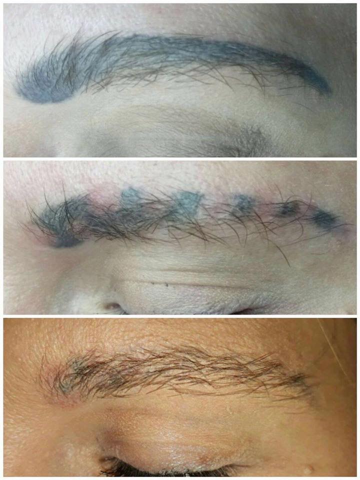 Skinial Non Laser Tattoo Removal Gold Coast and Northern NSW | 58 Oyster Point Rd, Banora Point NSW 2486, Australia | Phone: 0423 621 764