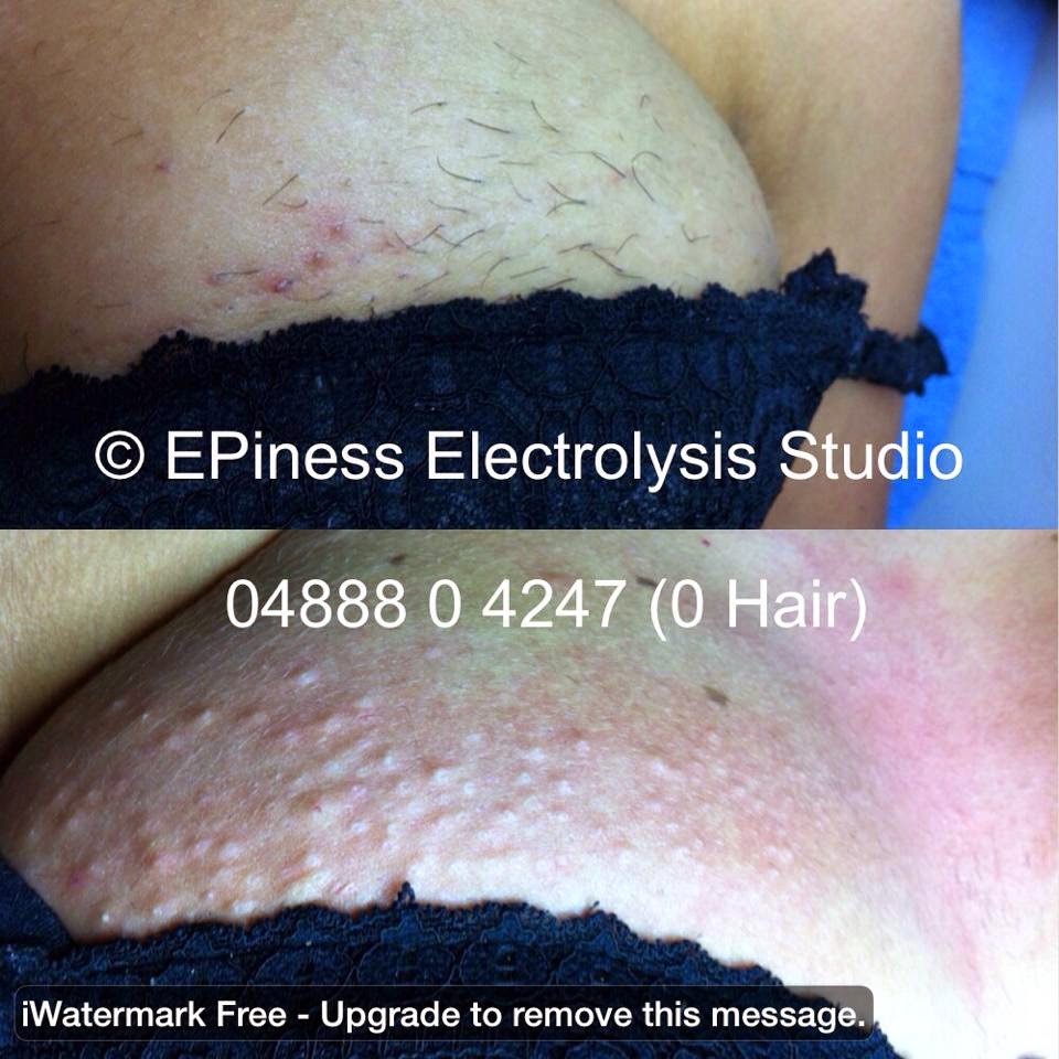 EPIness Electrolysis Studio | hair care | 10 Noble Dr, Epping VIC 3076, Australia | 0488804247 OR +61 488 804 247