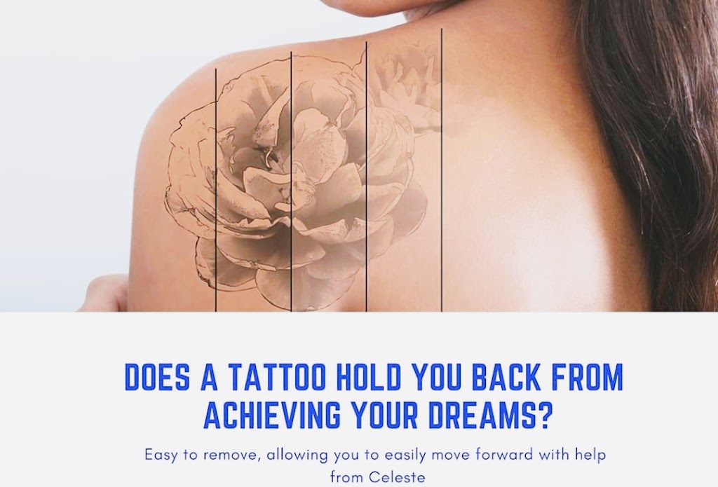 Tattoo removal lismore and beauty services | Fisher streer, Lismore NSW 2480, Australia | Phone: 0423 240 976