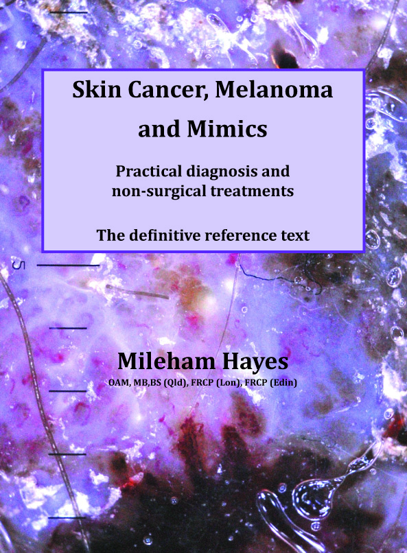MoleChex Melanoma and Skin Cancer Clinic | hospital | 5/268 Ipswich Rd, Annerley QLD 4103, Australia | 0738913044 OR +61 7 3891 3044