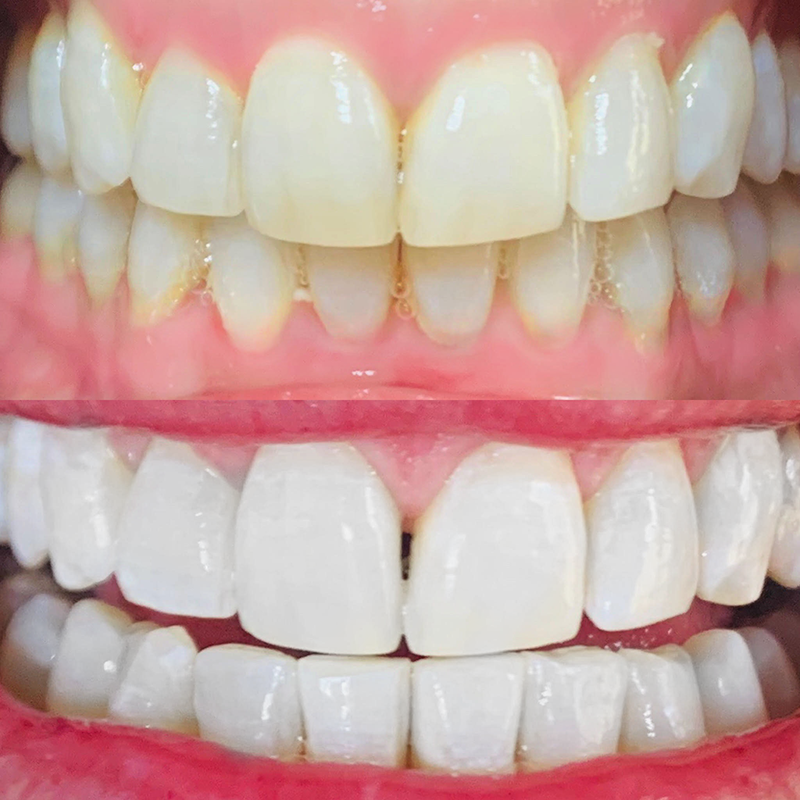 The Teeth Whitenin Co - Glenelg | dentist | 34 Ulinga St, Glenelg North SA 5045, Australia | 0401047857 OR +61 401 047 857
