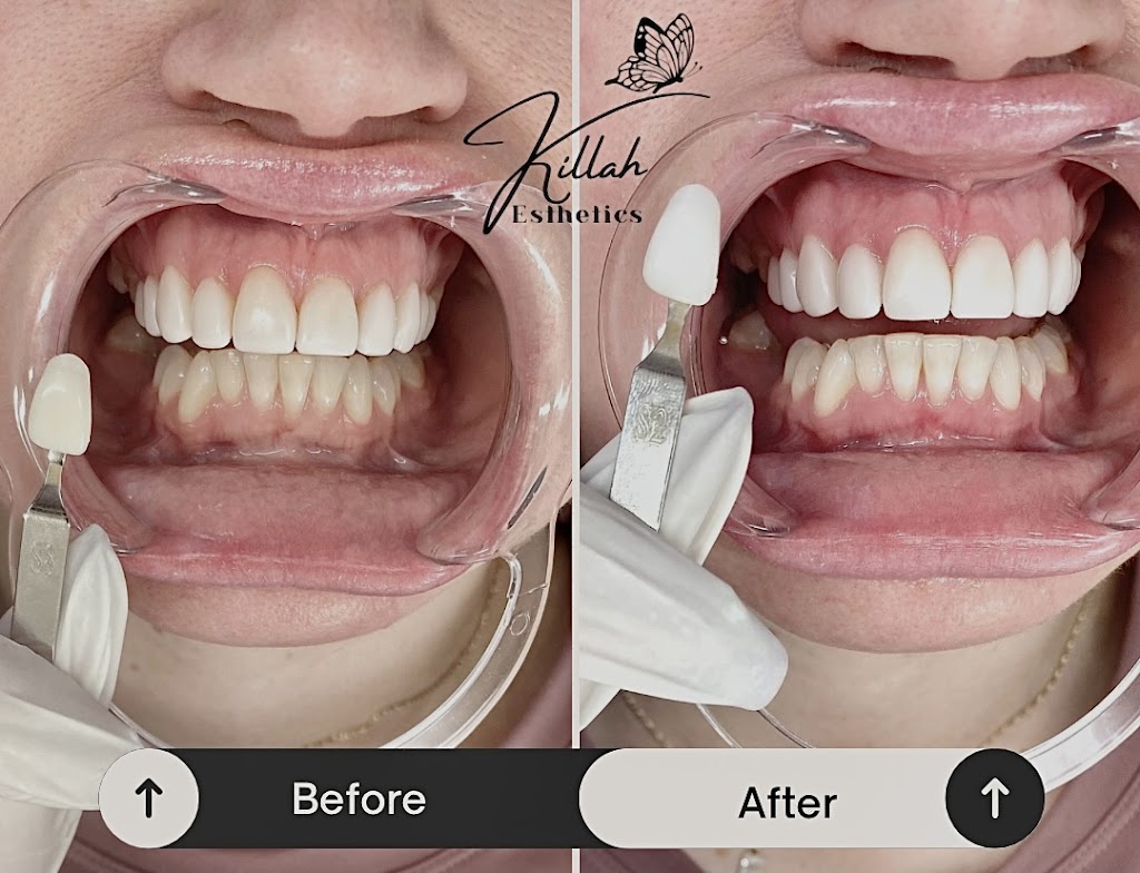 KillahEsthetics | 34 Wandewoi Ave, San Remo NSW 2262, Australia | Phone: 0422 214 280