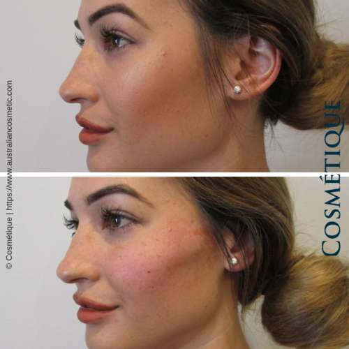 Cosmétique Cosmetic Surgery | Level 1/2/32 Myers St, Geelong VIC 3220, Australia | Phone: (03) 8595 3055