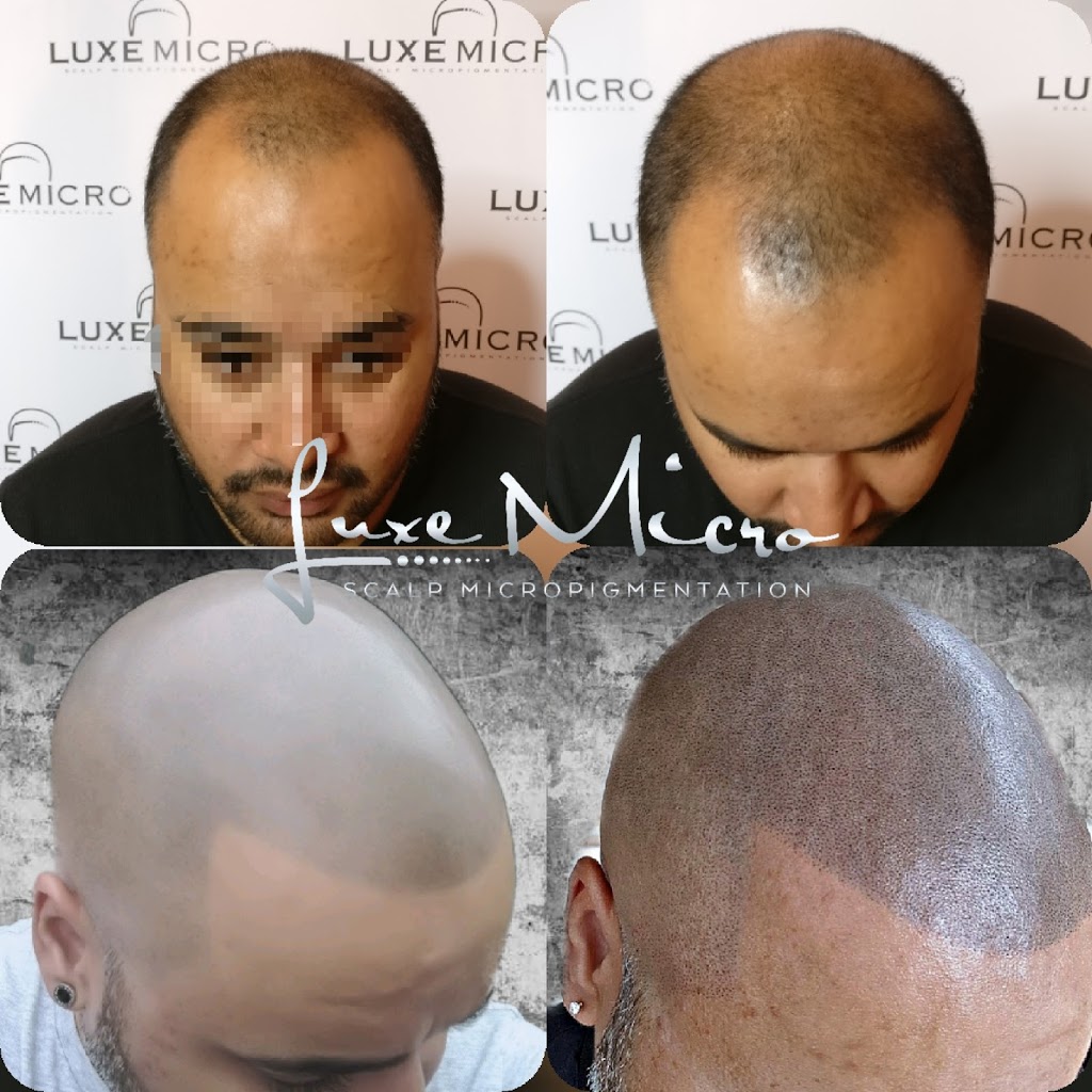 Luxe Micro, Scalp Micropigmentation Melbourne | hair care | 14 Ellaroo Circuit, Clyde North VIC 3978, Australia | 0451273940 OR +61 451 273 940