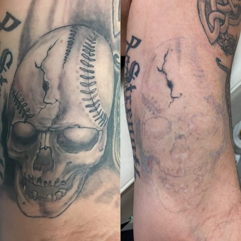 Gold Coast Tattoo Removal |  | 59 Church St, Boonah QLD 4310, Australia | 0402450901 OR +61 402 450 901