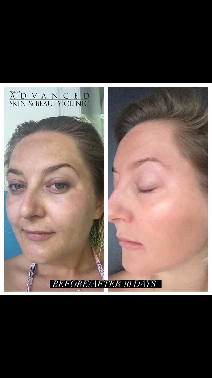 Advanced Skin & Beauty Clinic | 1/36 Mills St, Albert Park VIC 3206, Australia | Phone: (03) 9699 4000