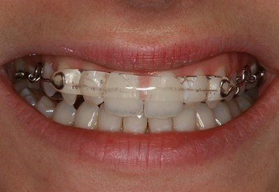 Prime Dental Group - Thornbury | dentist | 787A High St, Thornbury VIC 3071, Australia | 0394409430 OR +61 3 9440 9430