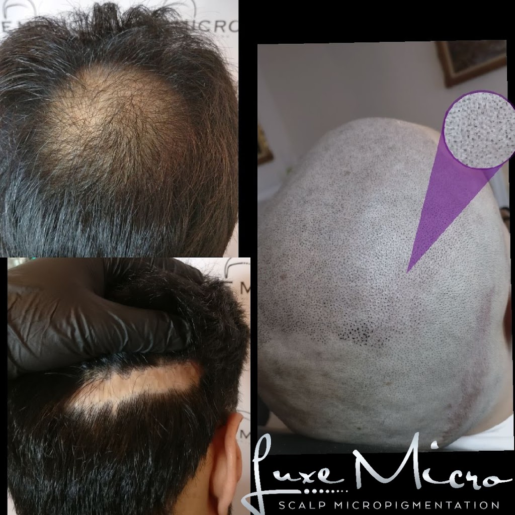 Luxe Micro, Scalp Micropigmentation Melbourne | 14 Ellaroo Circuit, Clyde North VIC 3978, Australia | Phone: 0451 273 940