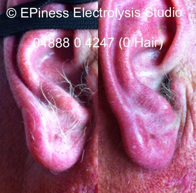 EPIness Electrolysis Studio | hair care | 10 Noble Dr, Epping VIC 3076, Australia | 0488804247 OR +61 488 804 247