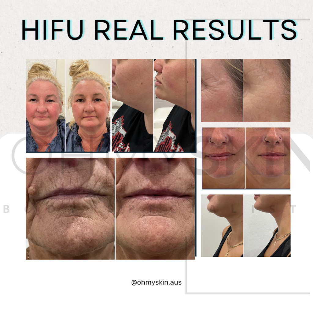 Oh My Skin Maitland | 43 Louth Park Rd, South Maitland NSW 2320, Australia | Phone: 0485 997 894