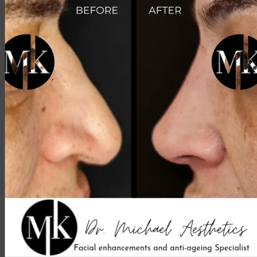 Non-surgical Rhinoplasty North Sydney | doctor | 46 Hercules St, Chatswood NSW 2067, Australia | 0280413293 OR +61 2 8041 3293