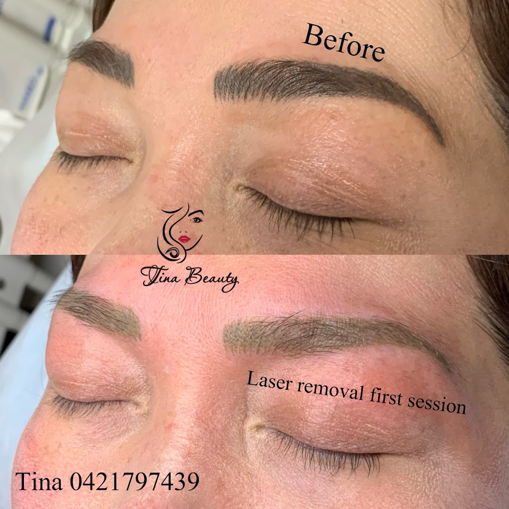 Melbourne Laser Eyebrows Tattoo Removal | beauty salon | 68 Spring Rd, Springvale South VIC 3172, Australia | 0403816410 OR +61 403 816 410