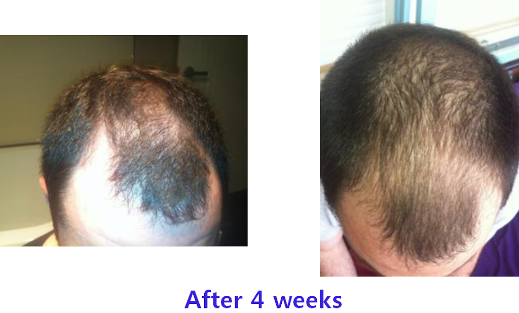 Hairgen Hair Loss Control Centre | hair care | 107/2 Rowe St, Eastwood NSW 2122, Australia | 0427427232 OR +61 427 427 232