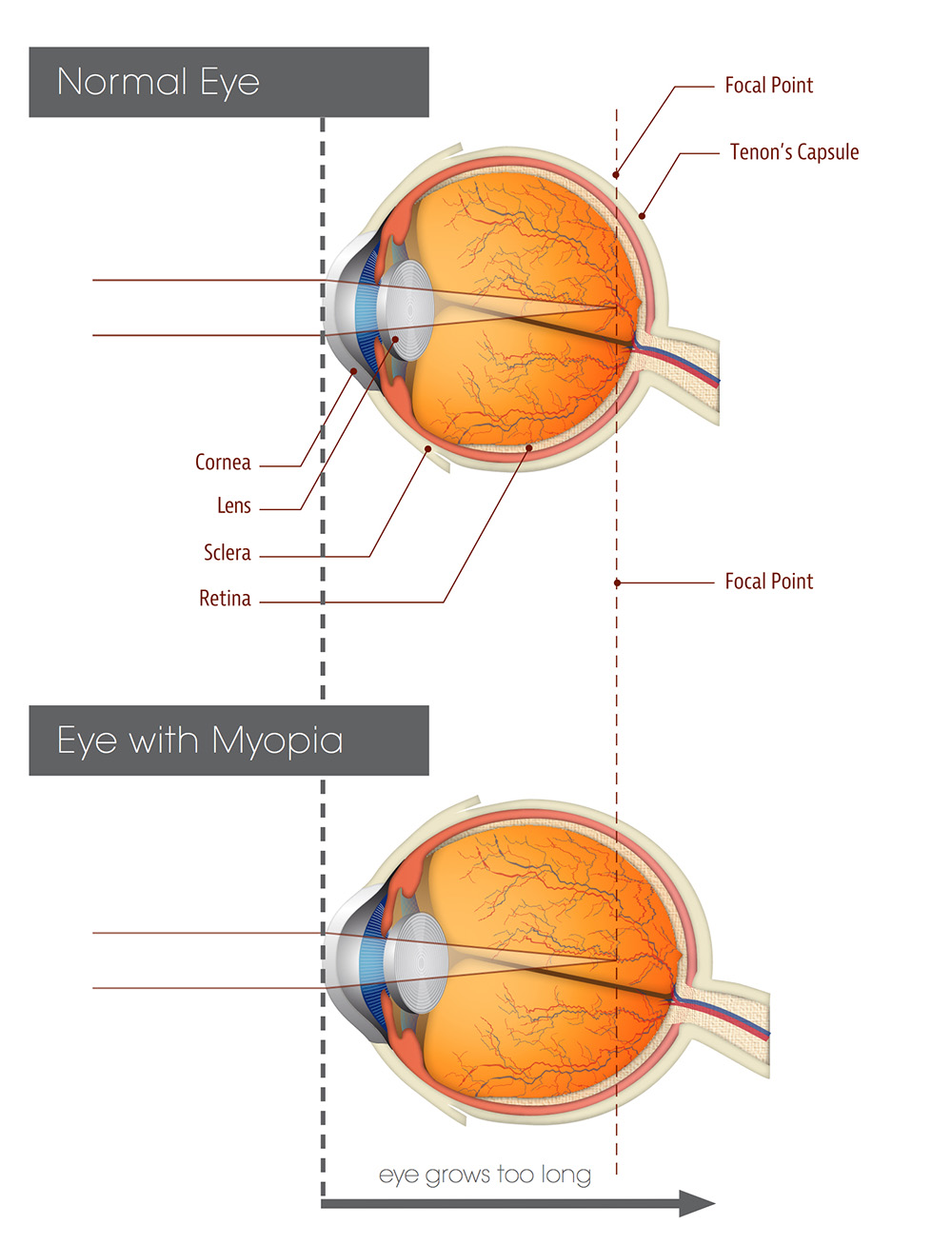 Kids Ortho K | Melbourne Myopia Clinic | health | 761 High St, Kew East VIC 3102, Australia | 0398197695 OR +61 3 9819 7695