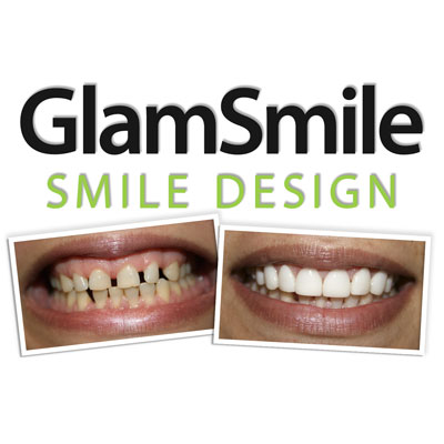 Glamsmile - Dr Bhayani | dentist | 67 Elizabeth Dr, Liverpool NSW 2170, Australia | 1300452676 OR +61 1300 452 676
