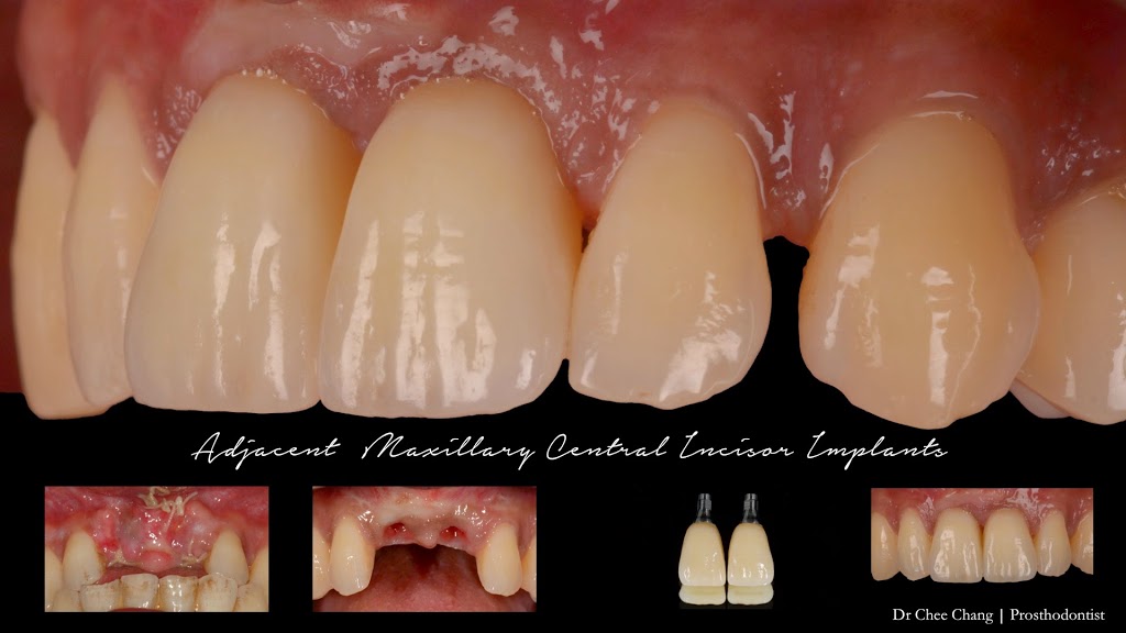 Dr Chee Chang | Prosthodontist | dentist | 1568 Malvern Rd, Glen Iris VIC 3146, Australia | 0398854591 OR +61 3 9885 4591