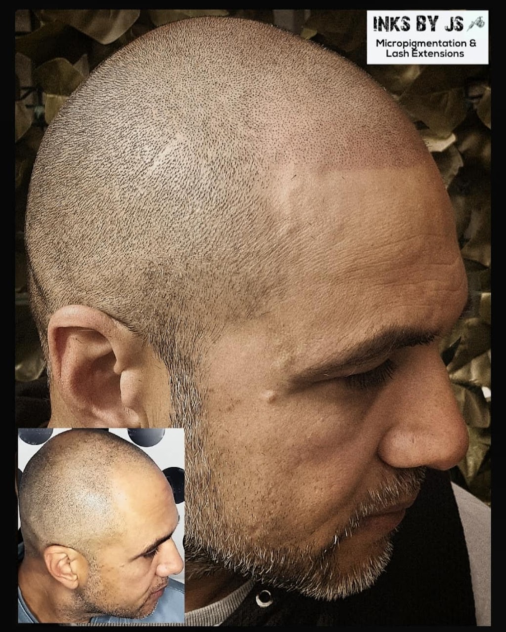 Scalp Micropigmentation SMP Melbourne Inks by JS | hair care | Sayers Rd, Tarneit VIC 3029, Australia | 0421844551 OR +61 421 844 551
