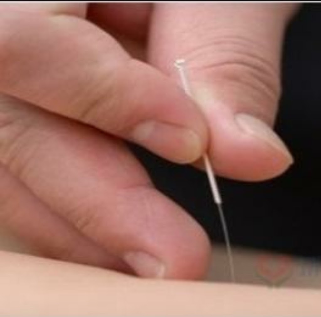 Acupuncture - Helen | 5 Hollington Cres, Point Cook VIC 3030, Australia | Phone: 0403 478 032