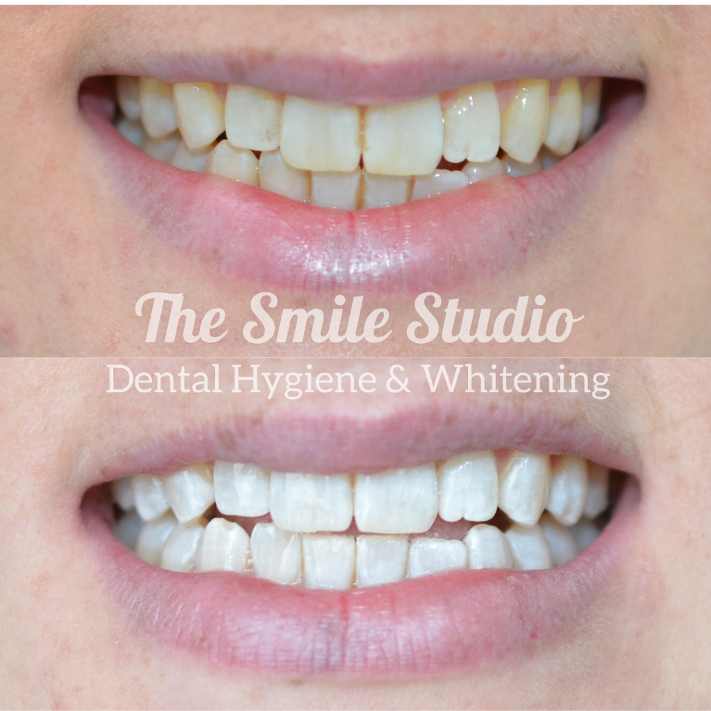 The Smile Studio Dental Hygiene & Whitening | 373 Main St, Bairnsdale VIC 3875, Australia | Phone: 0407 303 232