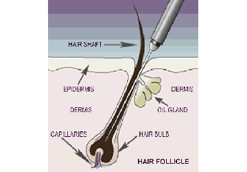 SISTER PERROTT ELECTROLYSIS - Hair Removal & Electrolysis specia | hair care | Servicing all Sydneys North Shore, Asquith, Thornleigh, Turramurra, Pymble, Gordon, Cherrybrook, Pennant Hills, Ryde, Epping, St Ives, 11/151-153 Pacific Hwy, Hornsby NSW 2077, Australia | 0294827774 OR +61 2 9482 7774