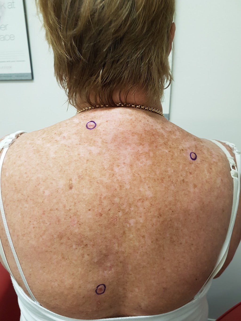 The Skin Spot Clinic | 1/123-125 Link Rd, Victoria Point QLD 4165, Australia | Phone: (07) 3667 8970