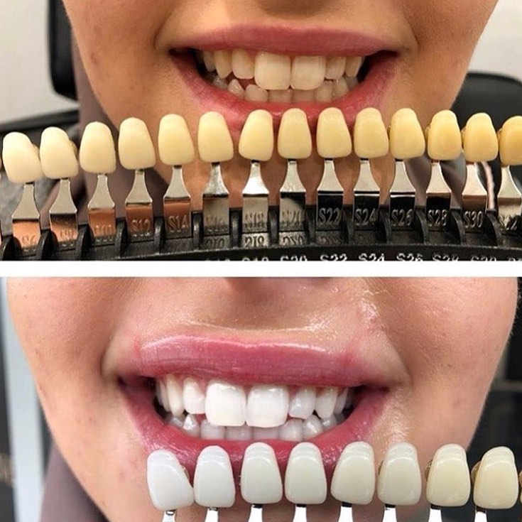 PureSmile Teeth Whitening Merrylands | dentist | 1/81-83 Merrylands Rd, Merrylands NSW 2160, Australia | 1300858199 OR +61 1300 858 199