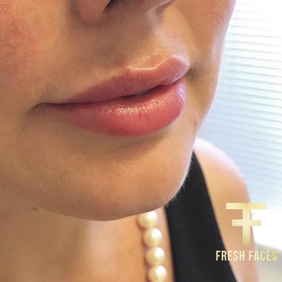 Fresh Faces Cosmetic Medicine Alfred Cove | hair care | 571A Canning Hwy, Alfred Cove WA 6154, Australia | 0862770165 OR +61 8 6277 0165