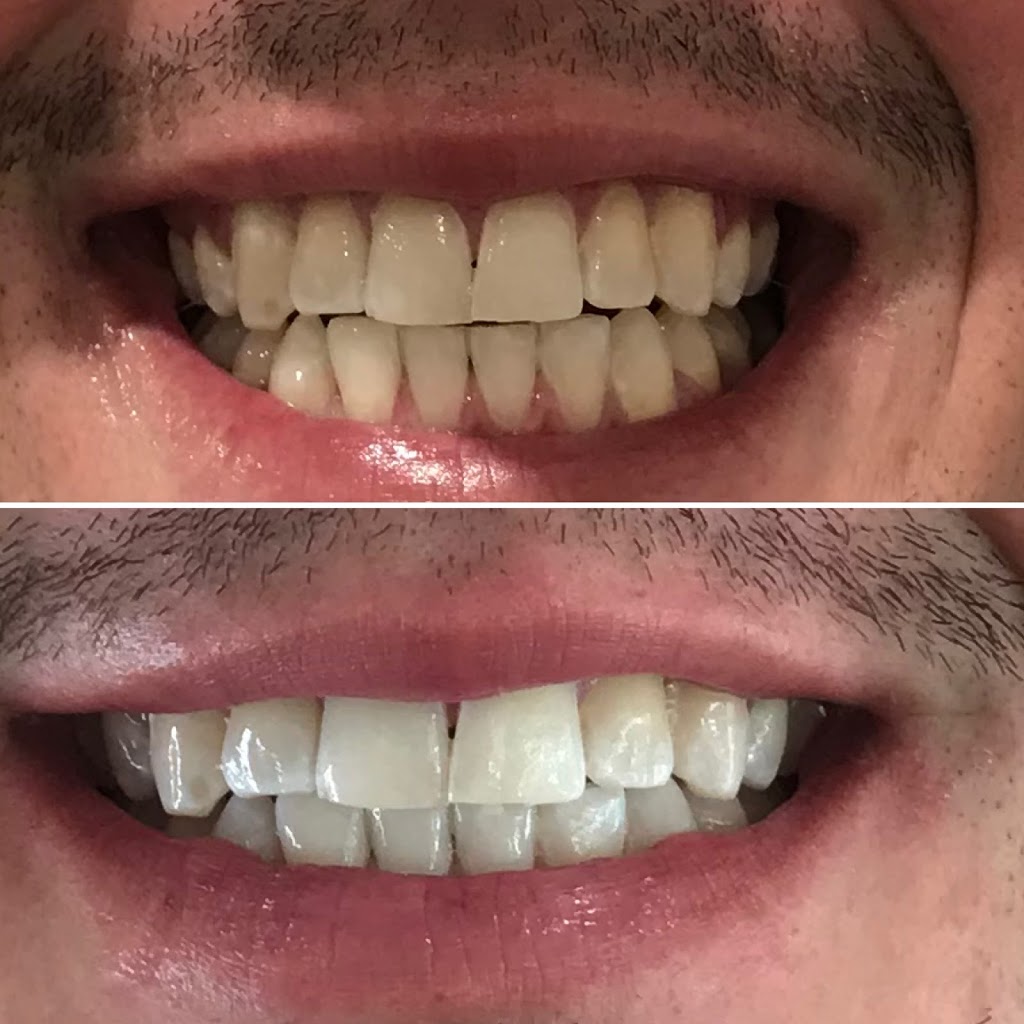 SassySmiles Brisbane Mobile Teeth Whitening & SprayTanning | dentist | Molloy Rd, Cannon Hill QLD 4170, Australia | 0417768595 OR +61 417 768 595