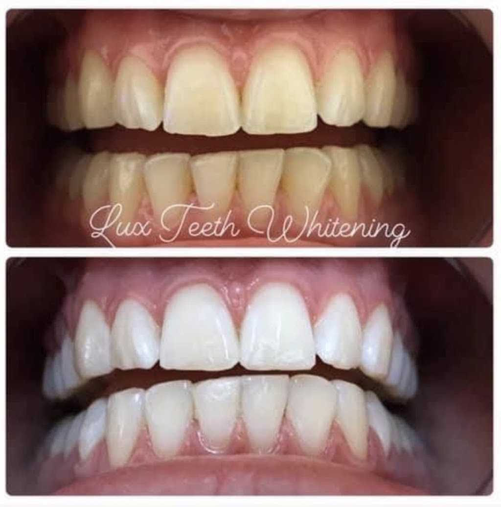 Lux Teeth Whitening | health | Seaspray Lifestyle Centre, 28 Cocoanut Point Dr, Zilzie QLD 4710, Australia | 0437386738 OR +61 437 386 738