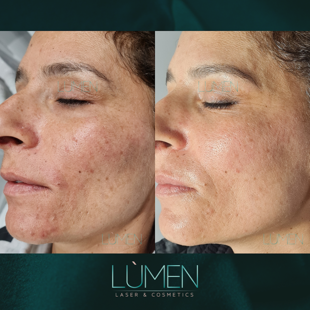 Lumen Laser & Cosmetics | beauty salon | 10 Rayfield Rd, Mernda VIC 3754, Australia | 0452511592 OR +61 452 511 592