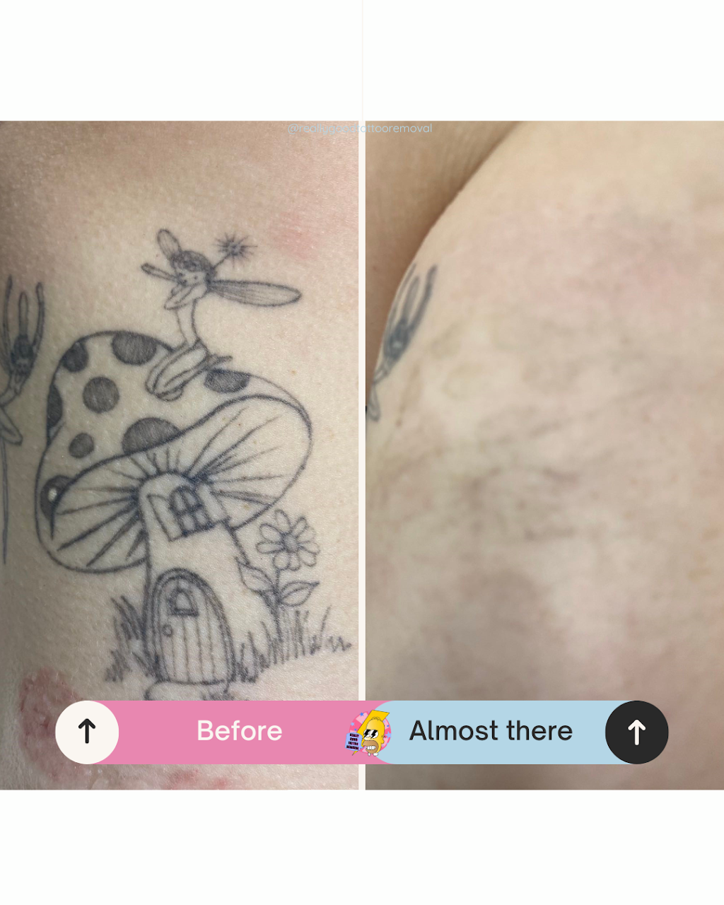 Really Good Tattoo Removal | 47 Clayton St, Sandgate QLD 4017, Australia | Phone: 0413 006 477