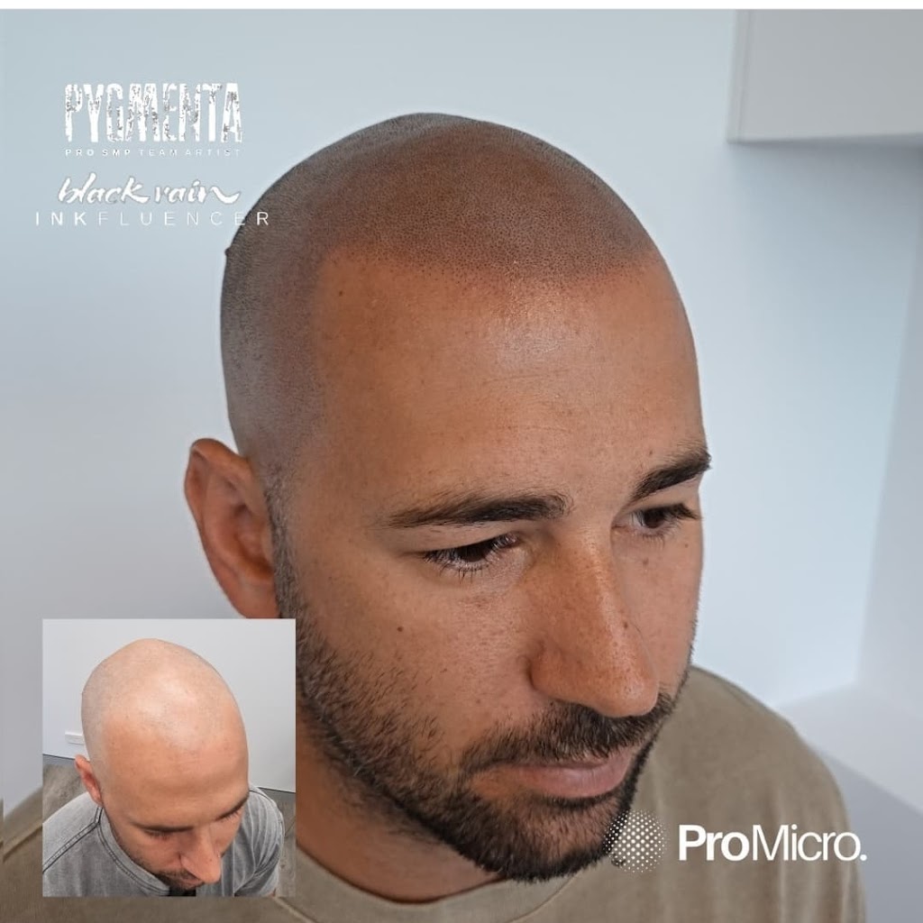 Pro Micro - Scalp Micropigmentation SMP | 23/58 Riverwalk Ave, Robina QLD 4226, Australia | Phone: 0437 778 852