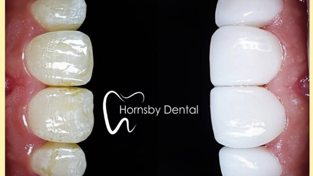 Hornsby Dental | 21/14 Edgeworth David Ave, Hornsby NSW 2077, Australia | Phone: (02) 8090 1100
