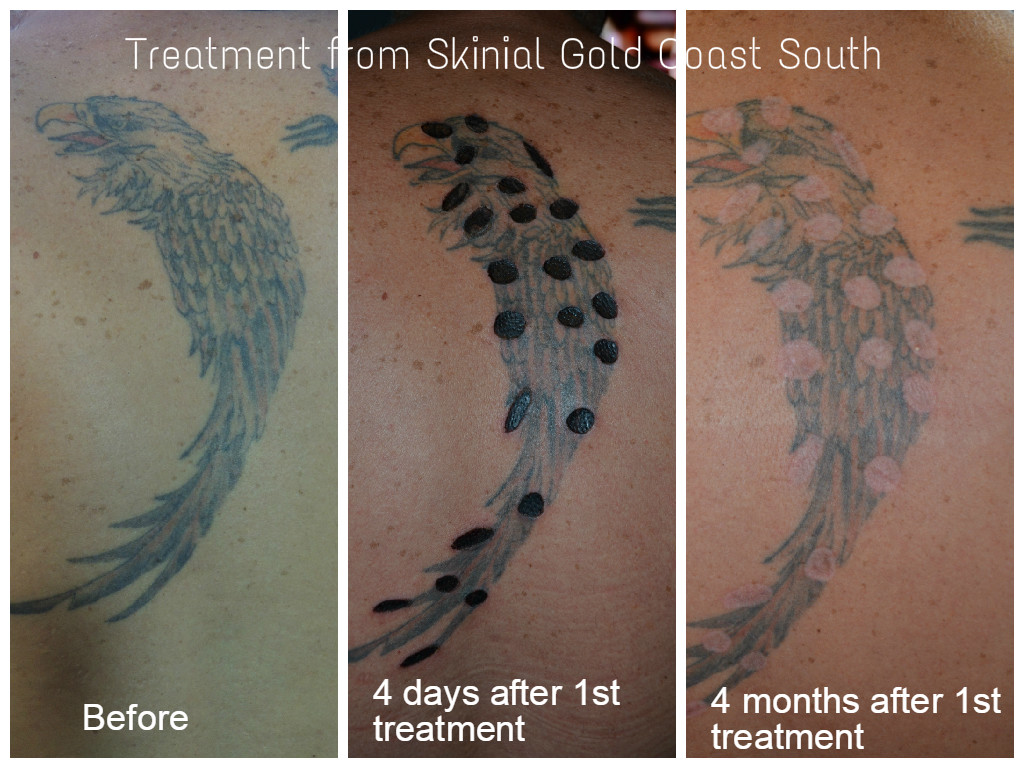 Skinial Non Laser Tattoo Removal Gold Coast and Northern NSW |  | 58 Oyster Point Rd, Banora Point NSW 2486, Australia | 0423621764 OR +61 423 621 764