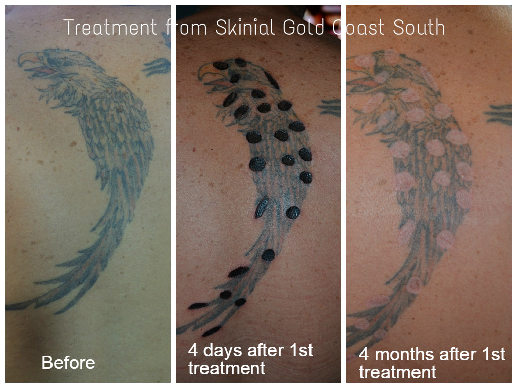 Skinial Non Laser Tattoo Removal Gold Coast and Northern NSW | 58 Oyster Point Rd, Banora Point NSW 2486, Australia | Phone: 0423 621 764